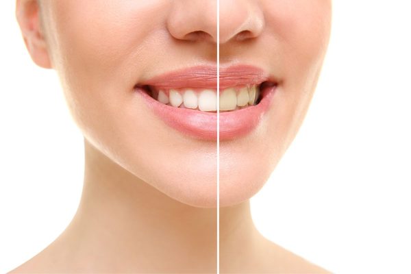 Bọc răng sứ là một trong những phương pháp cải thiện các khiếm khuyết về răng một cách hiệu quả, giúp chúng trở nên đồng đều và đẹp hơn.
